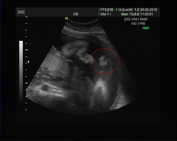 Фото узи 14 недель беременности мальчик